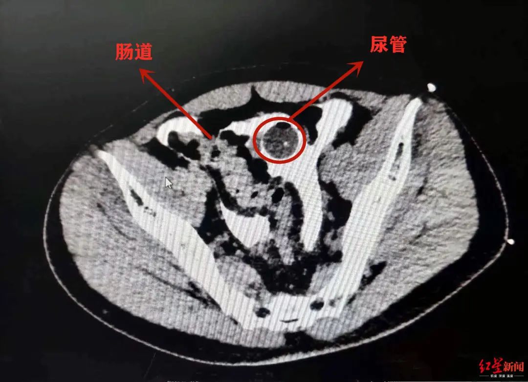 膀胱破裂图片