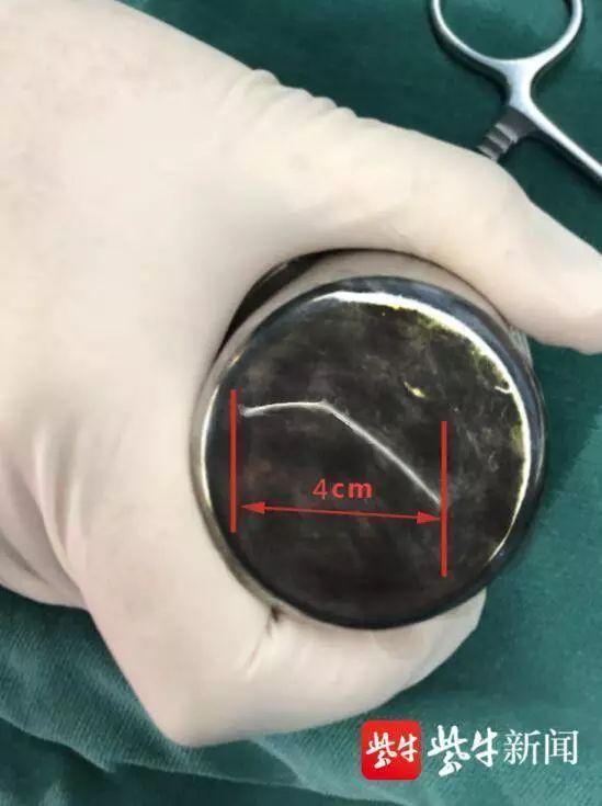 做一次喉镜取一根鱼刺多少钱