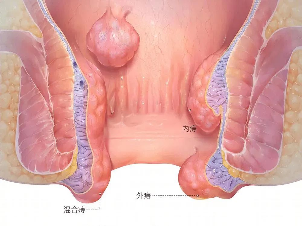肛门潮湿发痒,并非都是痔疮,还可能是这4个原因!