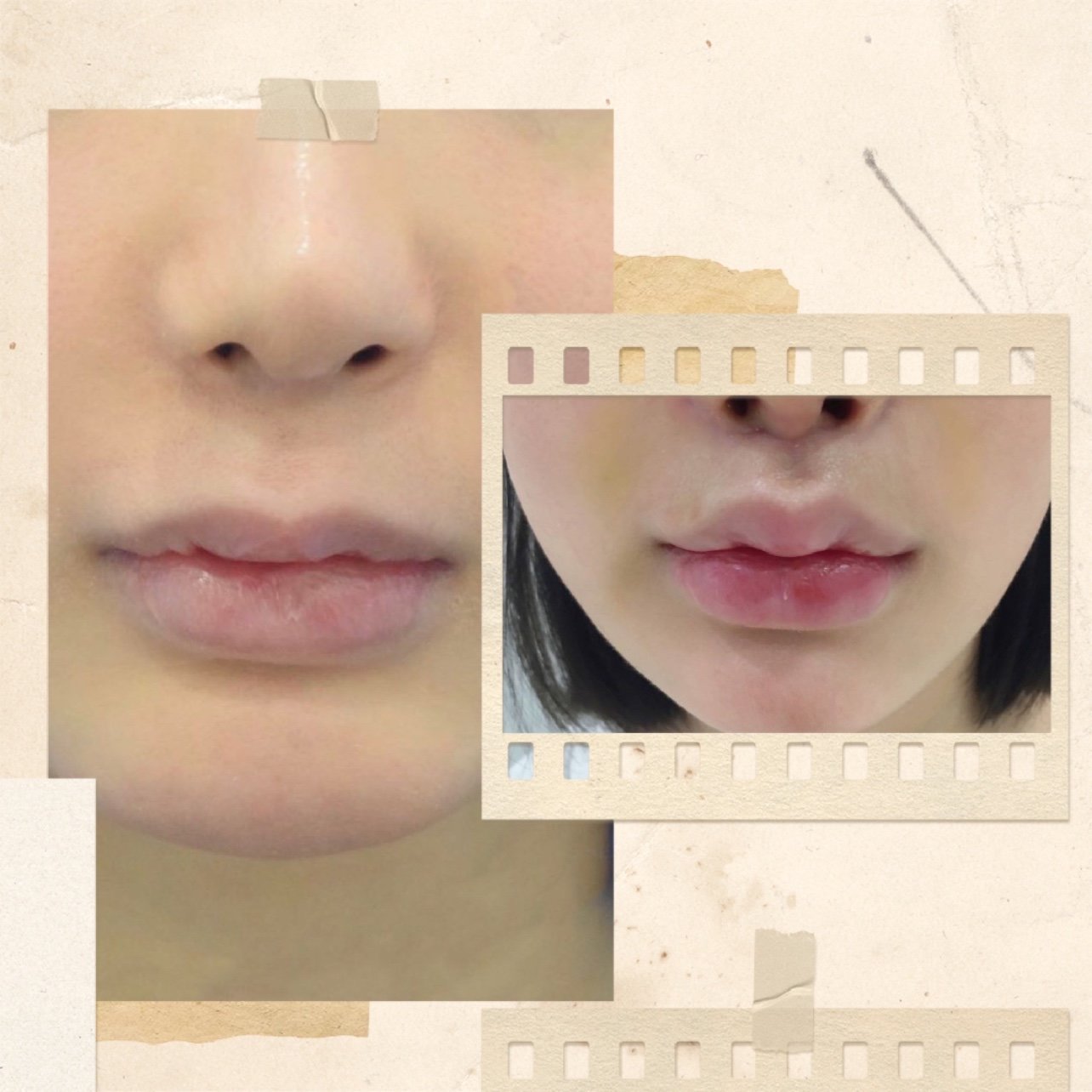 人中缩短术的原理是什么,术后该如何护理,做这个有何优势?