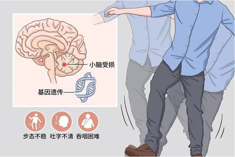 中期的小脑萎缩病都有哪些症状呢?可以治疗吗?