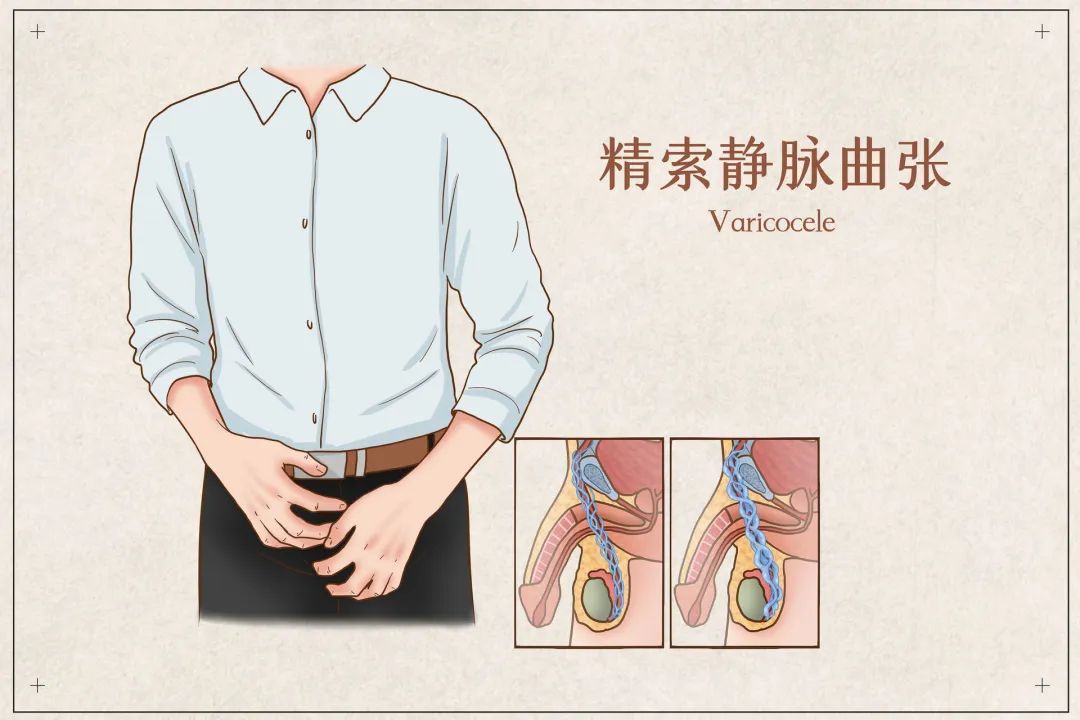 精索静脉曲张如果丁丁上经常出现包皮垢,不易清洗还反复发炎,就需要到