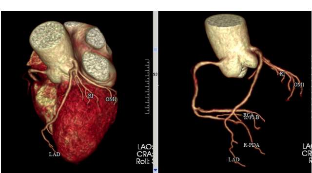 心脏检查,我该做冠脉cta还是冠脉造影?