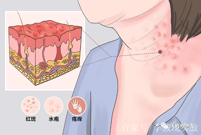 大皰性類天皰瘡:患病不治,久病成疾