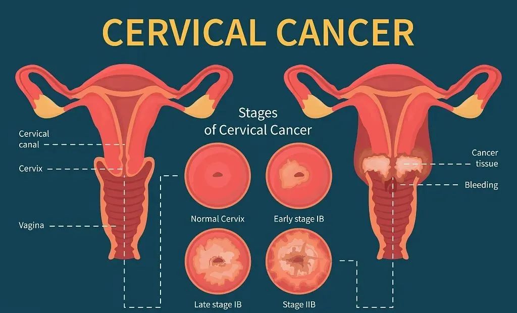 國外宮頸癌的發病率都在下降,但中國卻在上升!