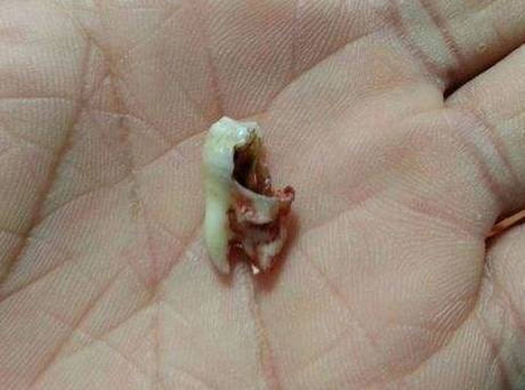 早晚刷牙为什么还长蛀牙?原来这才是护牙的根本?