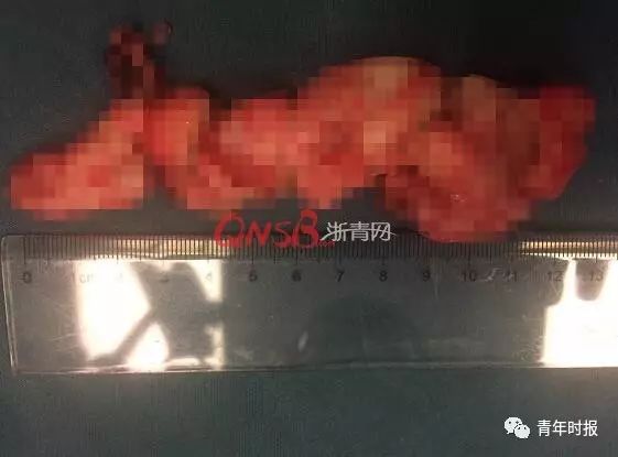 推荐|小伙明明很饿却食难下咽，原来食管深处竟有只“小狗”！医生：罕见