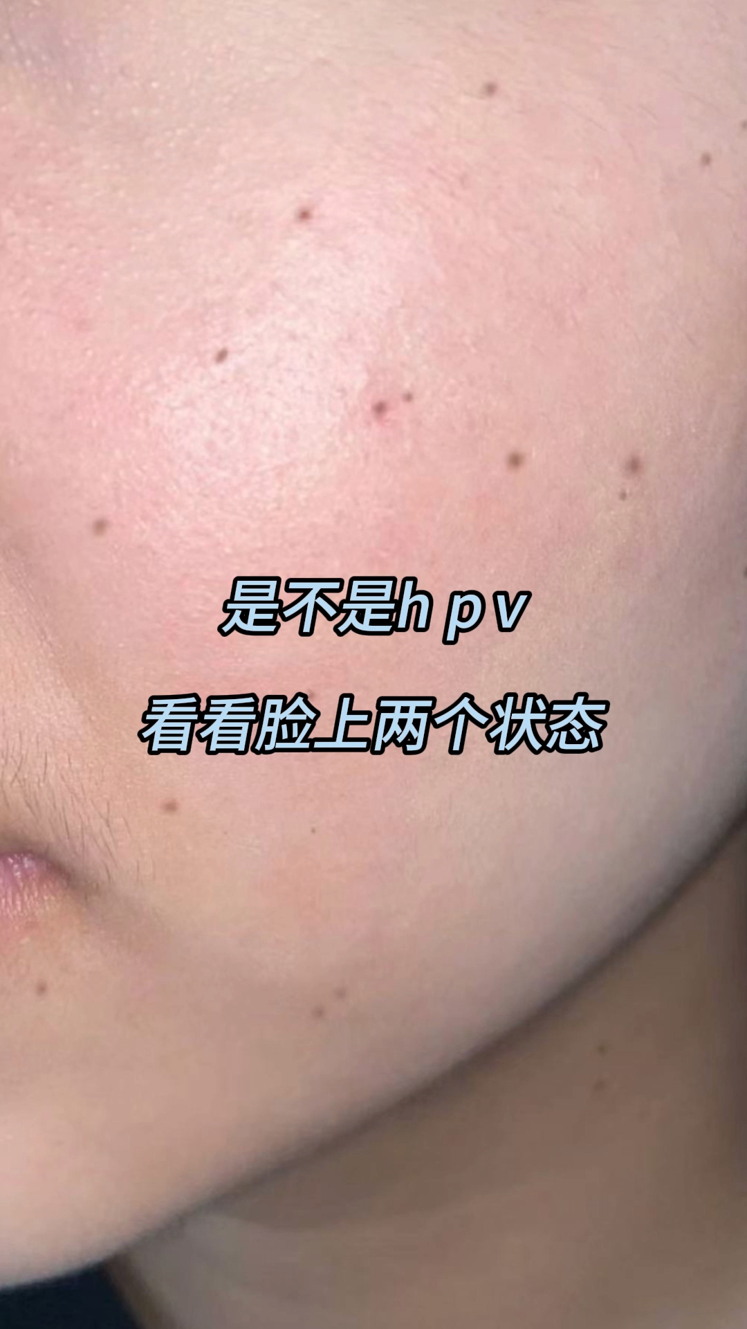 是不是hpv感染,看看脸上两个状态