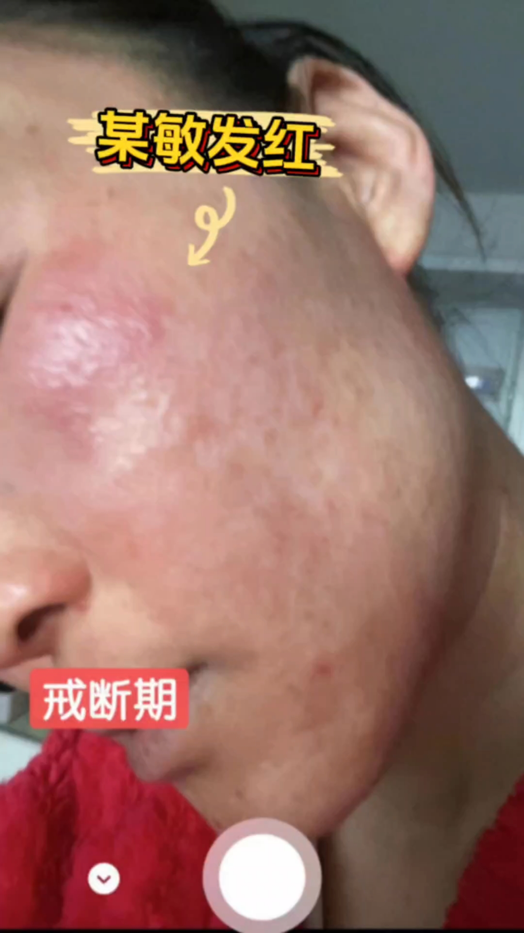 某敏发红了!#激素脸#敏感肌#皮肤问题