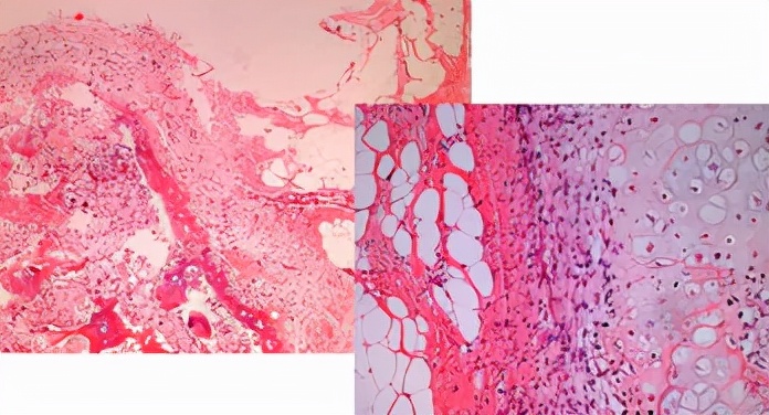 "软骨肉瘤"影响血液循环,治疗以外科手术为主,放疗无明显效果
