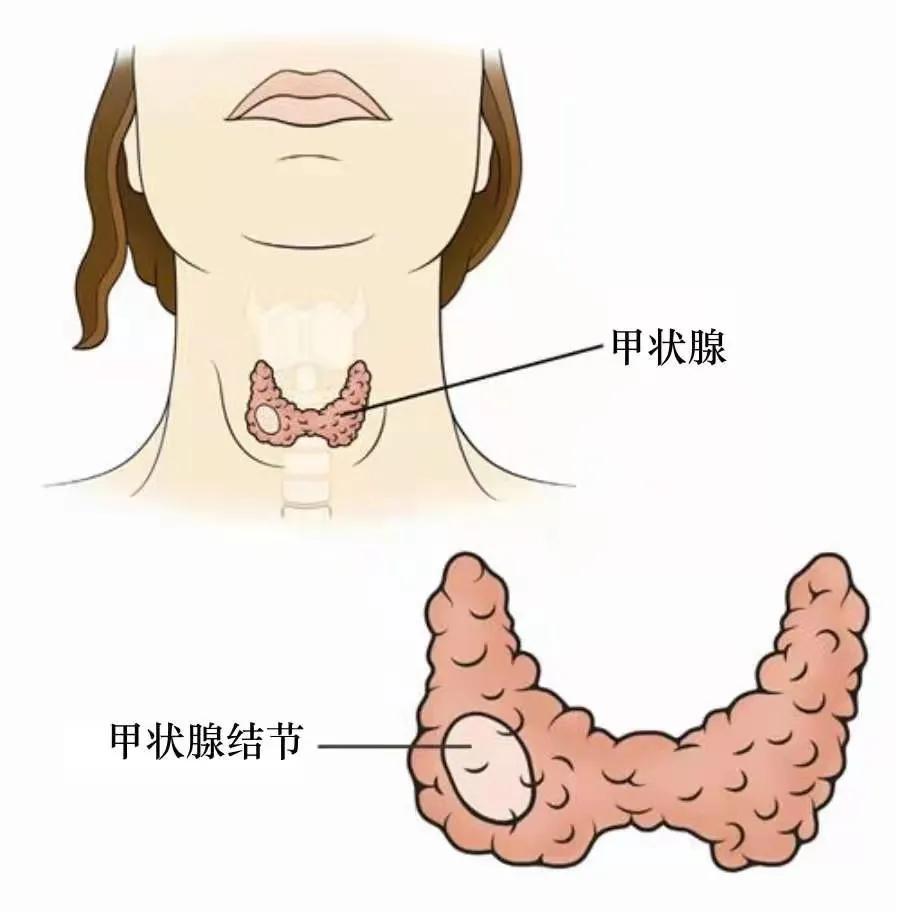 甲状腺在什么位置图片