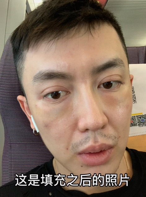 男网红整容变毁容,术后哭诉自己变老20岁,前后对比图令人诧异