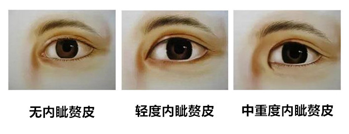 本来想做个双眼皮,为什么医生建议我开内眼角呢?