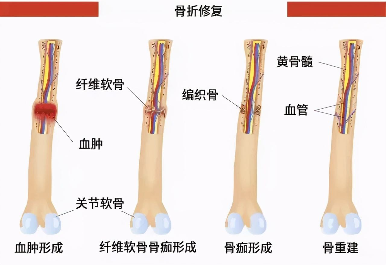 骨折愈合过程图片