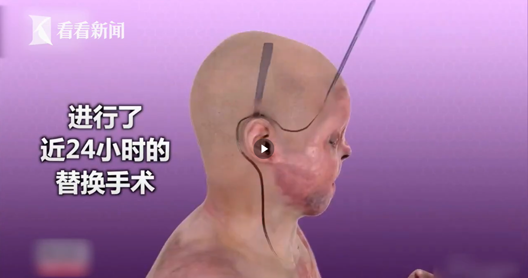 全球首例"换脸换手"手术成功 16个医生耗时23小时