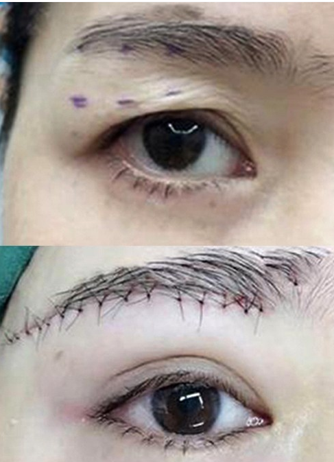 提眉手术能改善眼肌肤,是否真如此神奇?术后是否会留下后遗症?