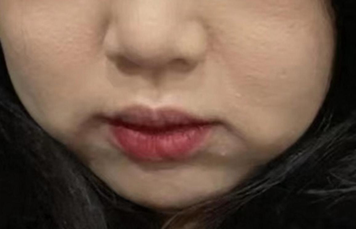 拍照时嘴角肌肉肉眼可见下垂,需要去除老化口角囊,看医美怎么做