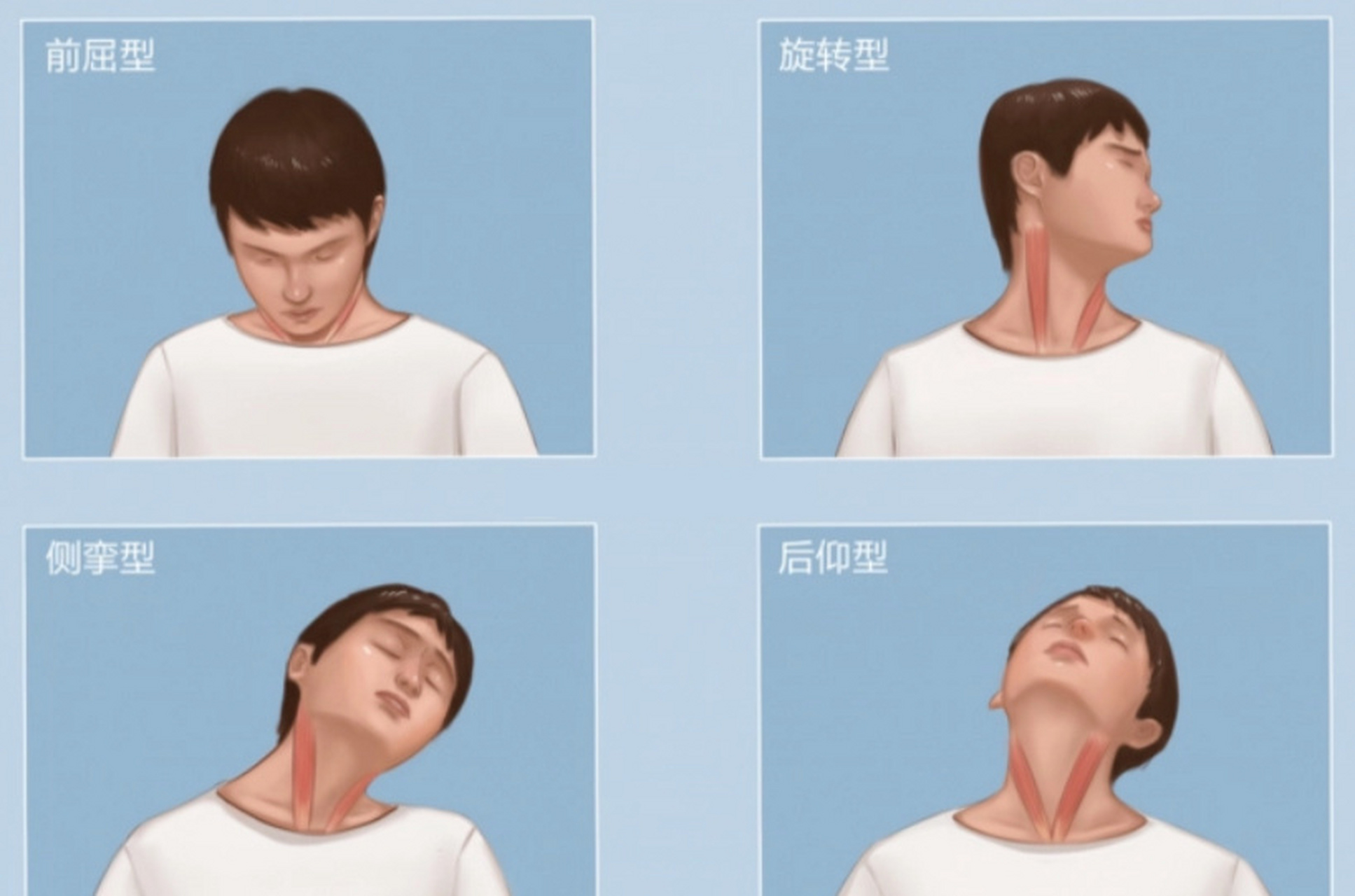 颈部肌肉痉挛图片