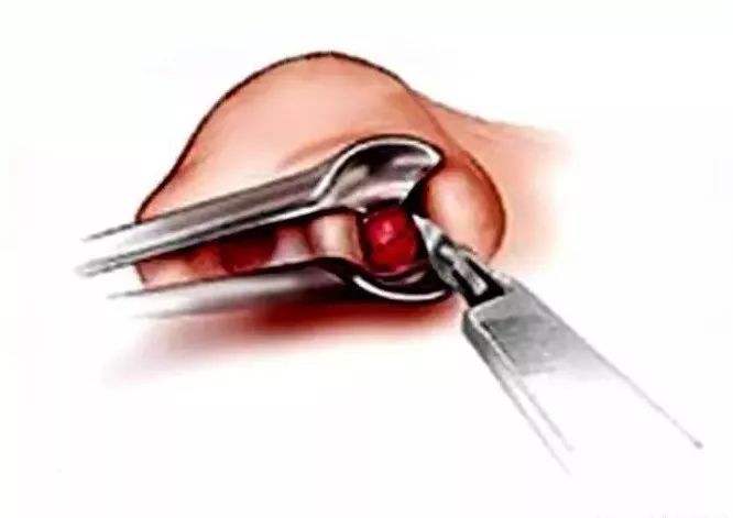 创伤性鼻中隔穿孔,多由头,面,鼻部外伤引起,可能并发嗅觉减退