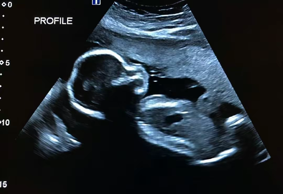 袖珍姑娘梁小小:出生时重2.1千克,身长33厘米,3岁时已停止生长