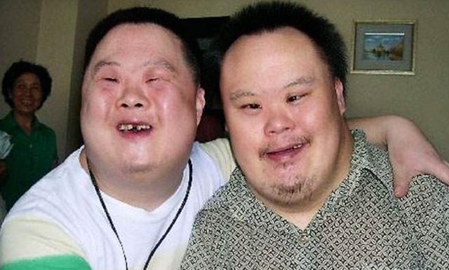 为什么唐氏综合征患者外貌都相似?没有遗传父母长相,长得都一样