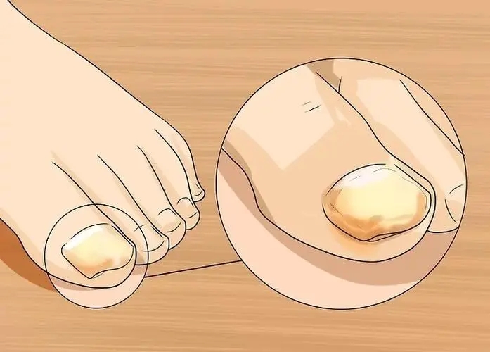 这些不良生活习惯会让灰指甲不请自来你有过吗