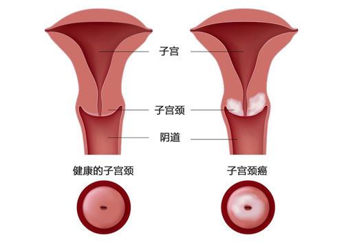 宫颈锥切——让宫颈癌无处遁形