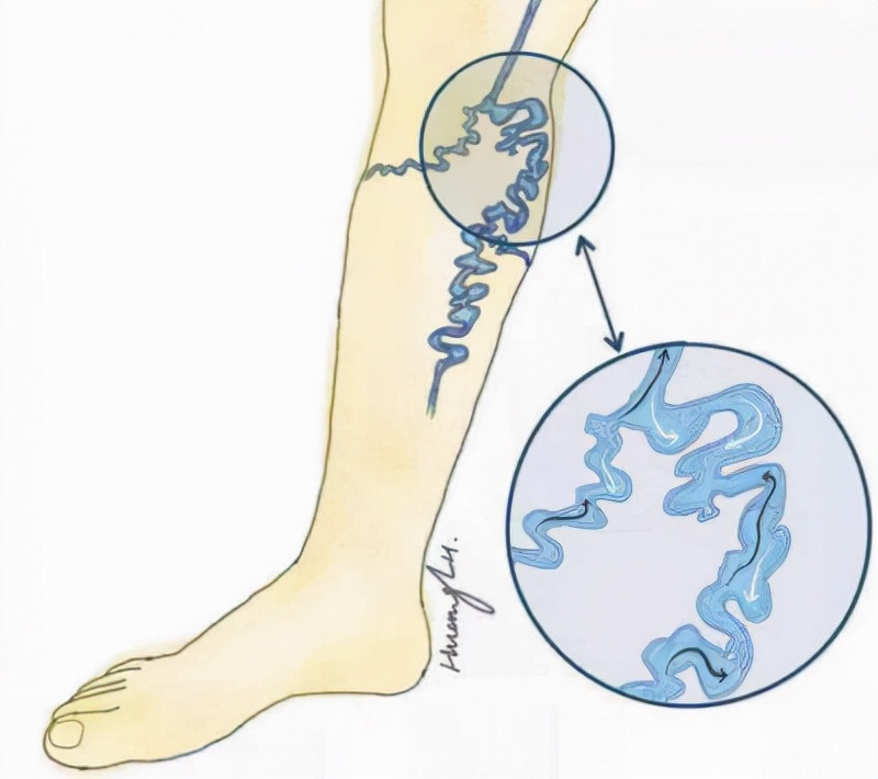 原发性下肢静脉瓣膜关闭不全,可能与遗传有关,预后一般较好