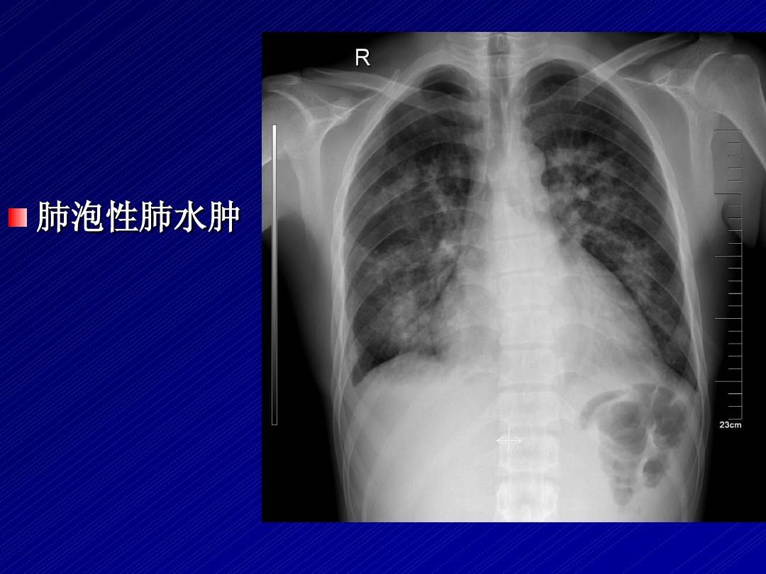 黏脂贮积症Ⅱ型,在出生时没有异常,症状有鼻涕增加,肝脏增大