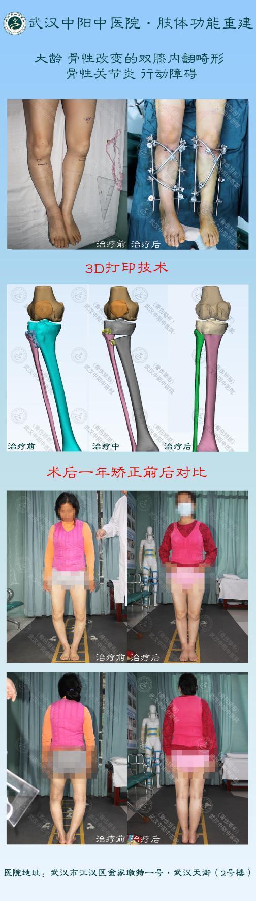 o型腿在哪里可以做手术 武汉中阳中医院微创矫正,手术矫正塑腿型