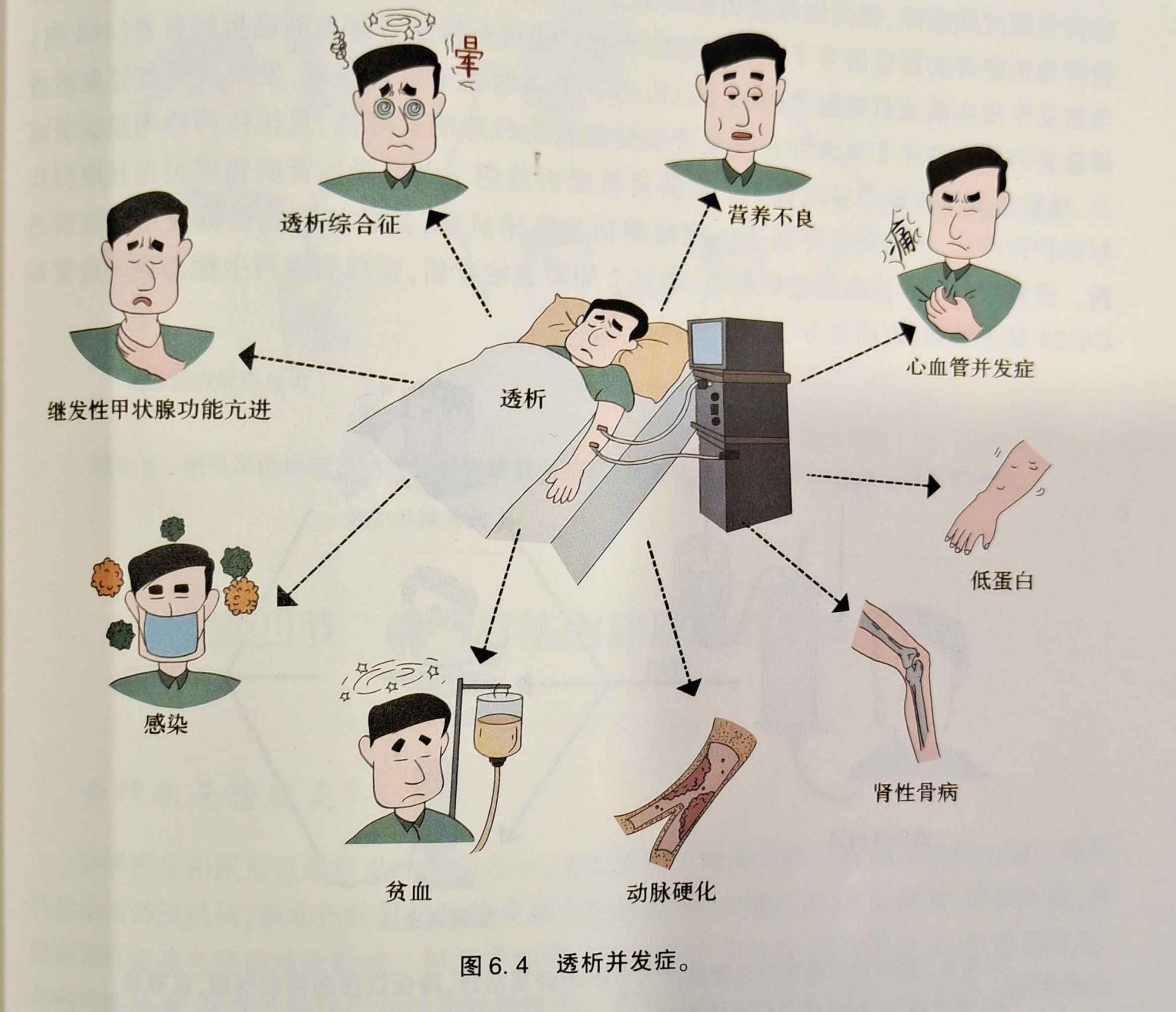 水义富氢水科普连载63:氢气疗法对透析并发症的缓解作用