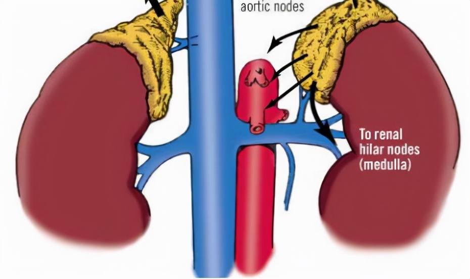 肾上腺转移癌,好发于患有恶性肿瘤的中老年人,男性多于女性