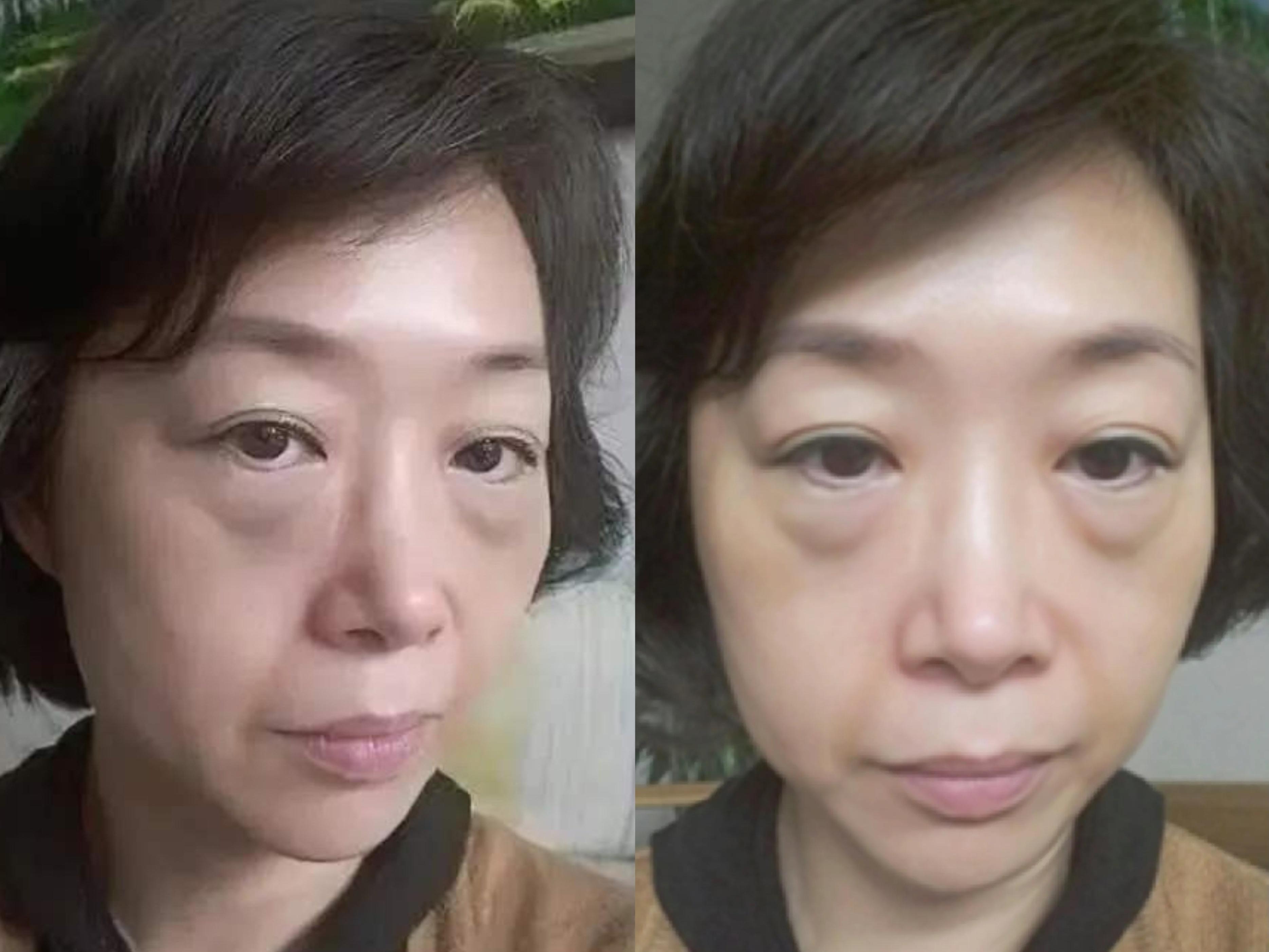 48岁眼袋膨出 苹果肌下垂,我去眼袋的同时做了苹果肌复位