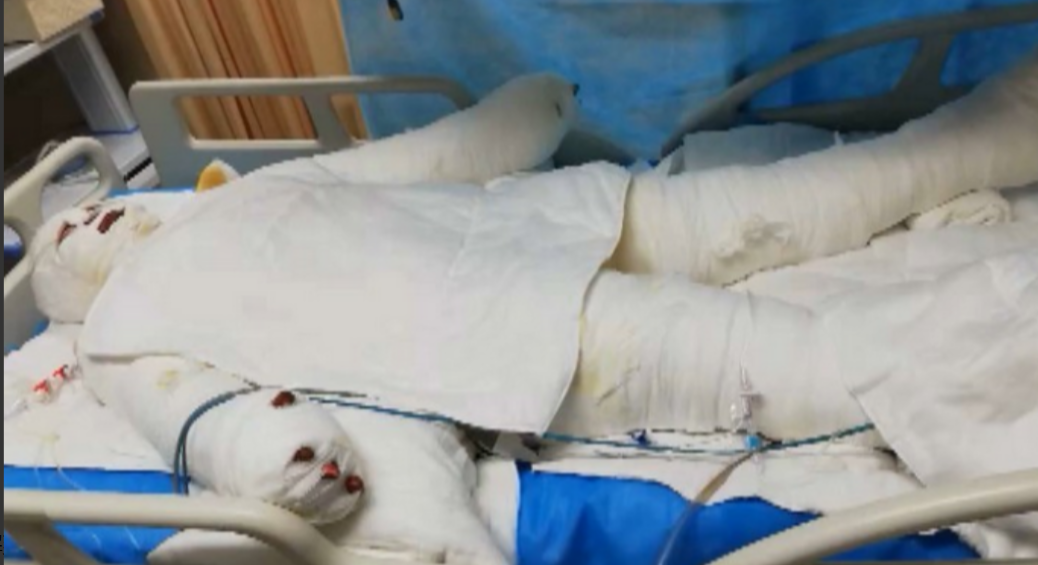 花季少女被烧伤