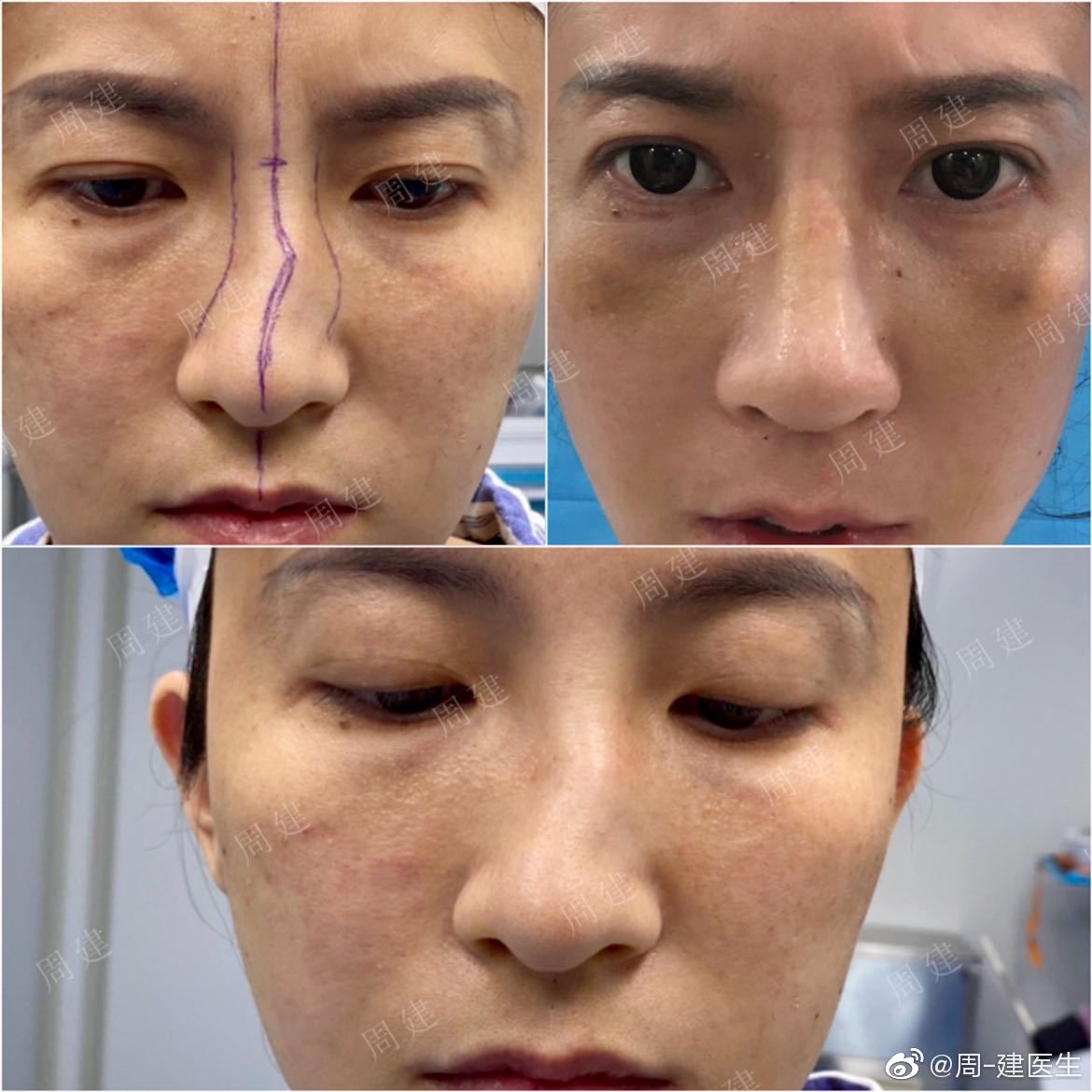 哑铃鼻基底,新术式不移位,郑州周建医生鼻整形专访