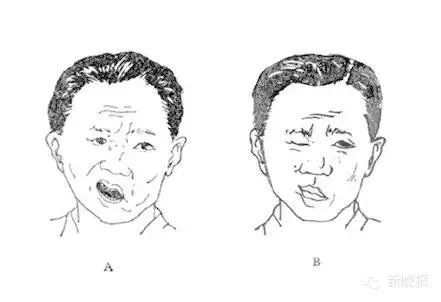 中风嘴歪图片大全图片图片