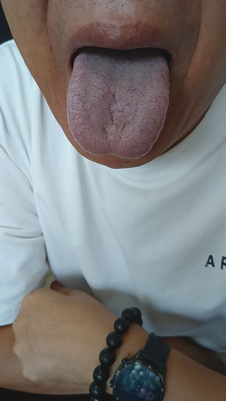 揭秘白腻苔真相:暗藏寒湿之谜