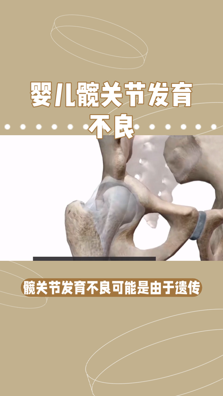 婴儿髋关节发育不良