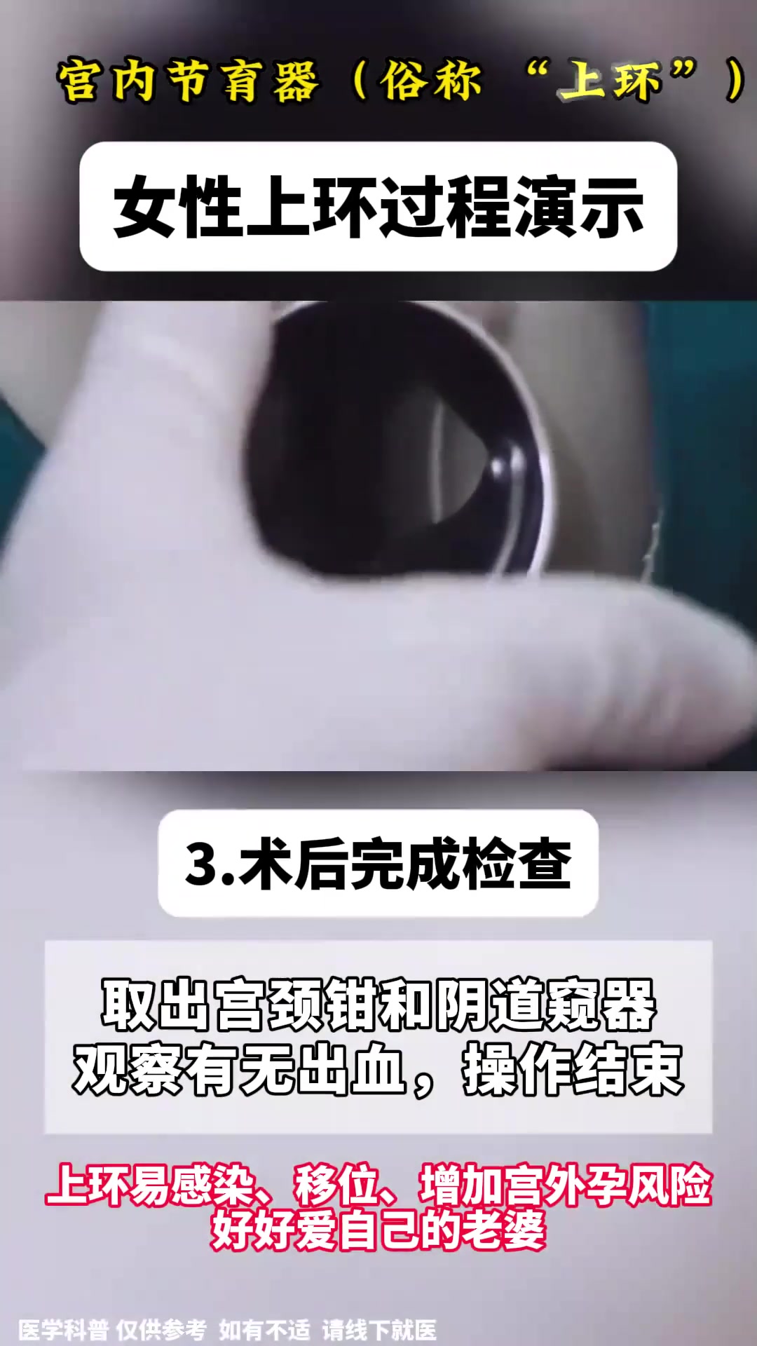 女性上环过程演示,好好爱自己的老婆!