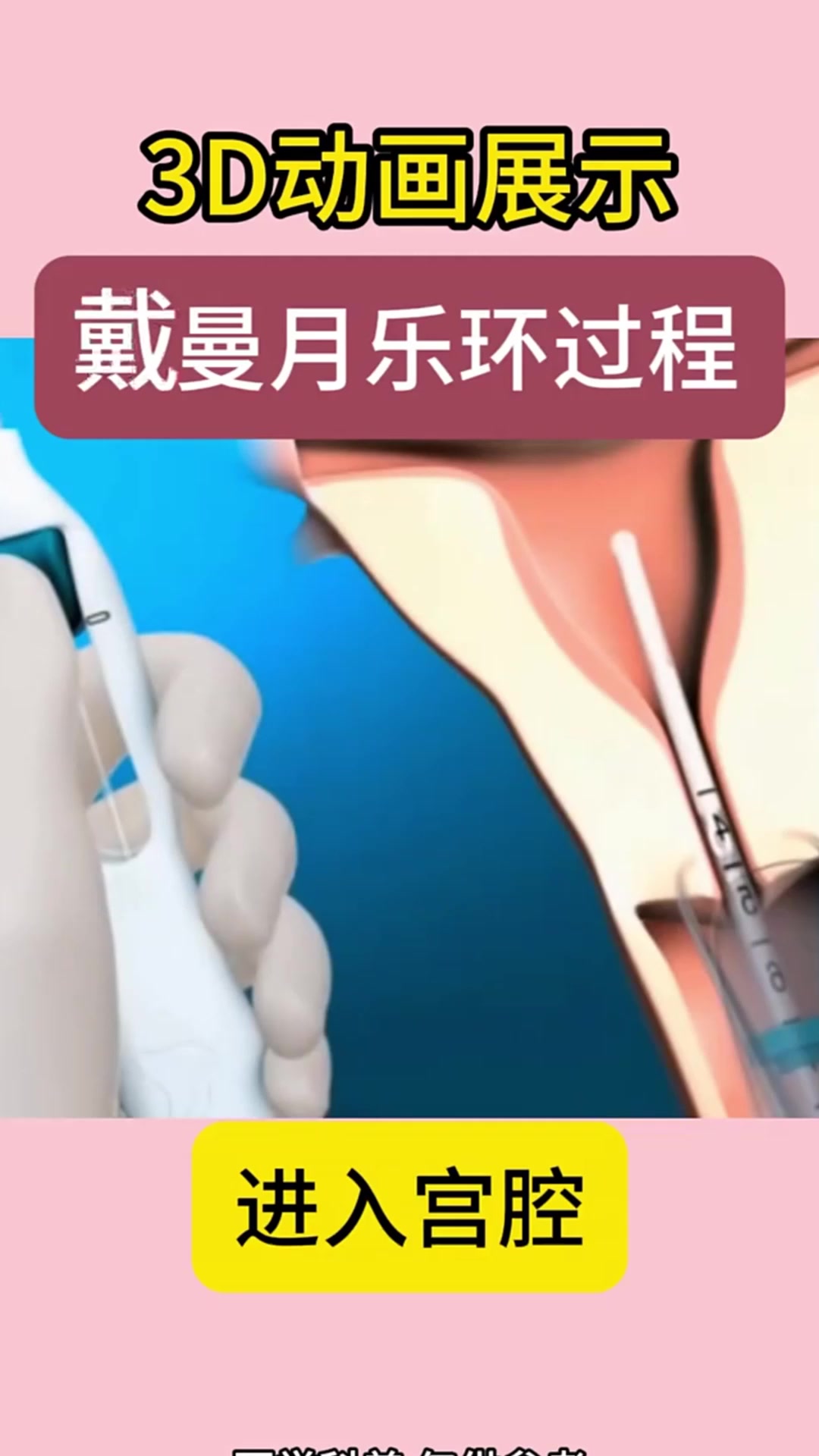 3d动画演示,带曼月乐环的过程