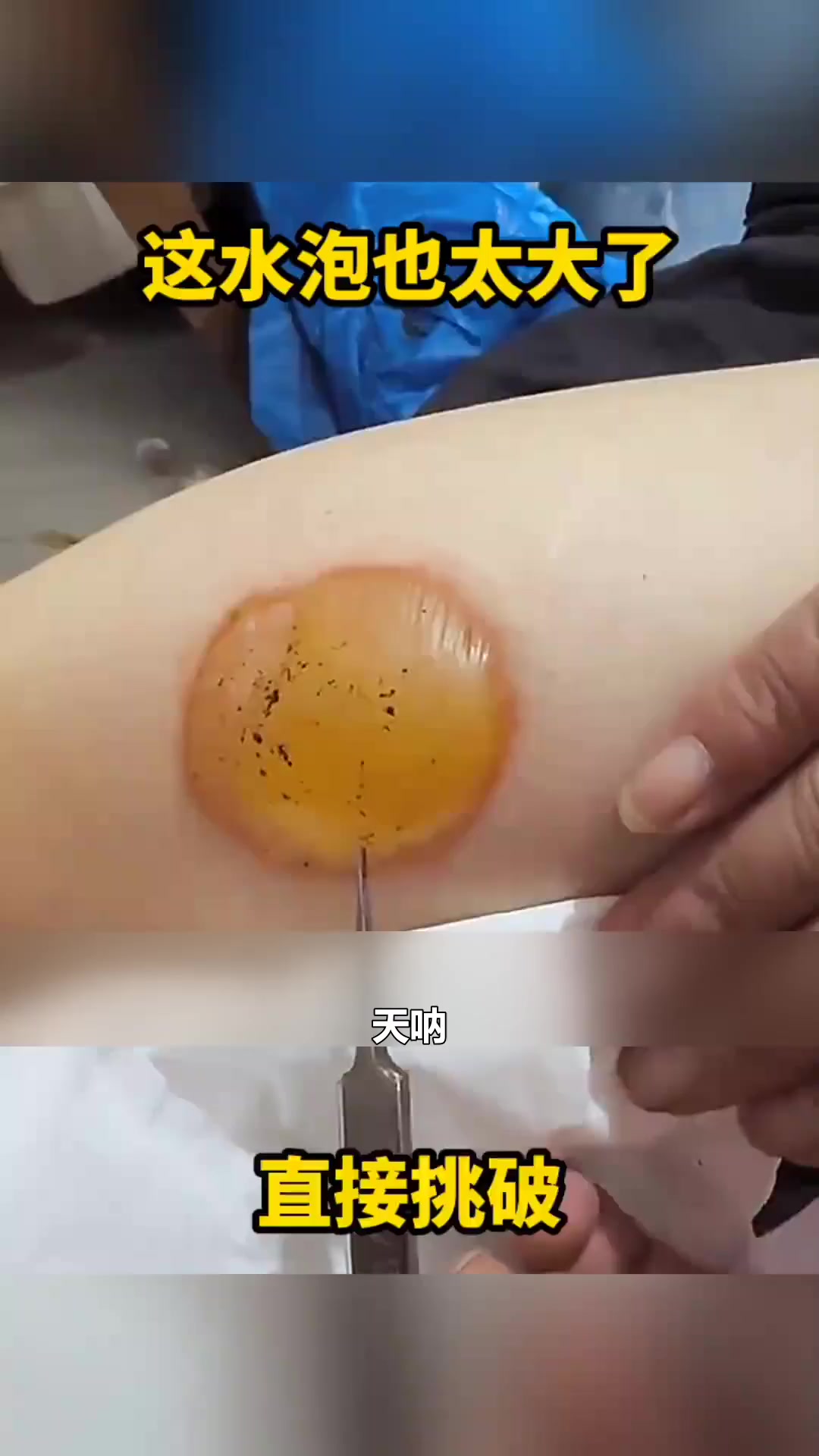 这水泡也太大了,直接挑破