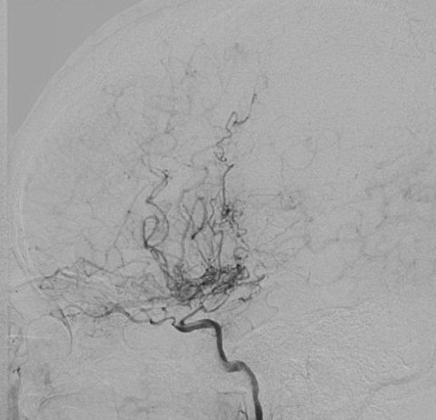 "烟雾病"小知识-宫安静