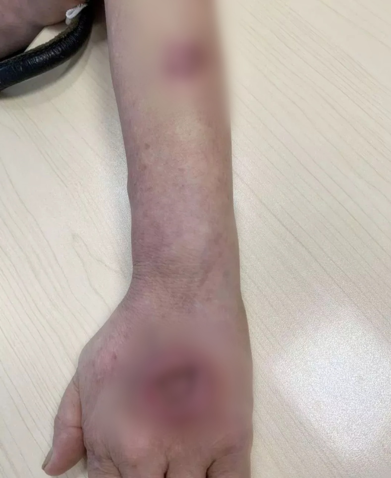 家务警惕！女子手背长出大窟窿差点截肢！竟是因为做这个家务活