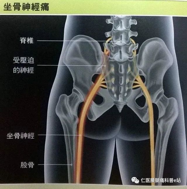 为什么腰椎间盘突出