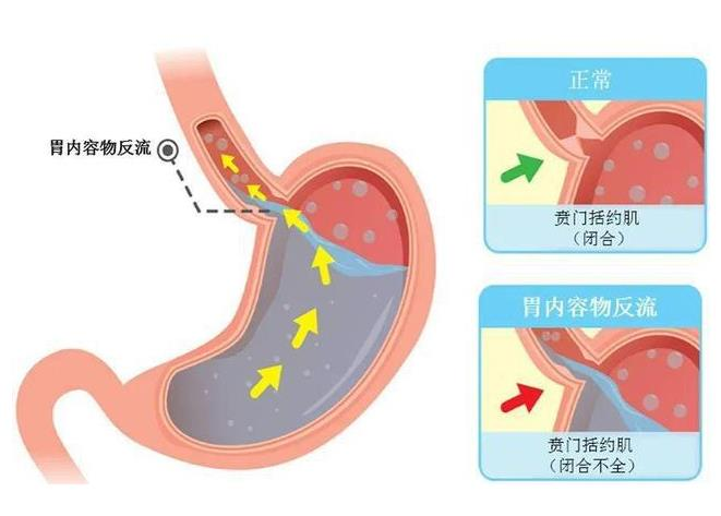 慢性非萎缩性胃炎 病例