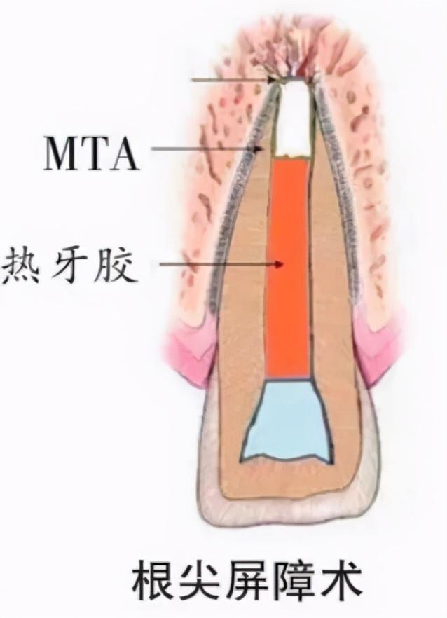 根尖孔未闭合?试试根尖屏障术