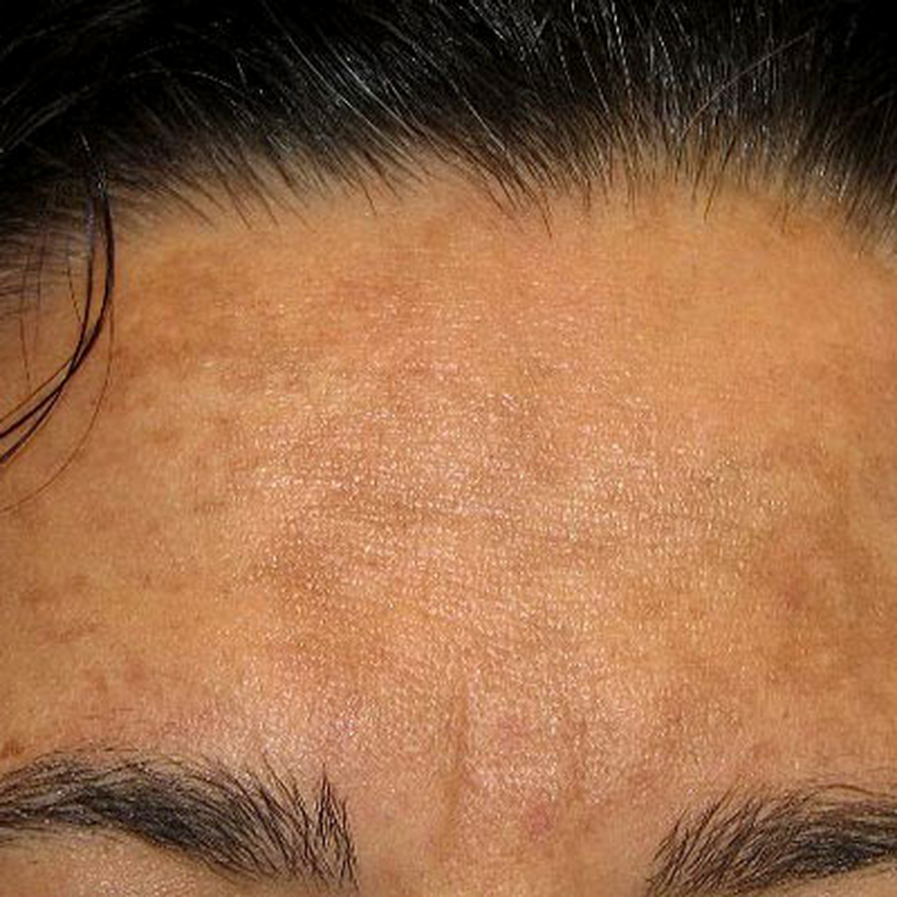 黄褐斑长在不同的地方,也在暗示不同的身体健康.