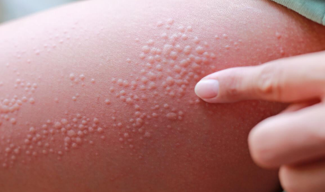 湿疹的前期症状是什么?