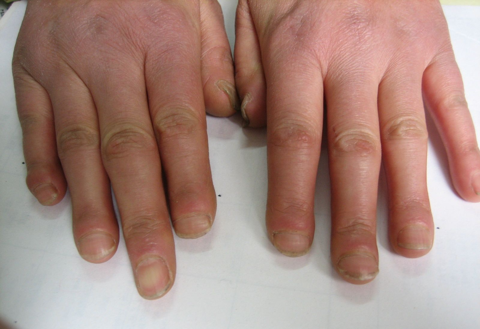 遗传性硬化性皮肤异色症,本病属罕见疾病,目前尚无满意疗法