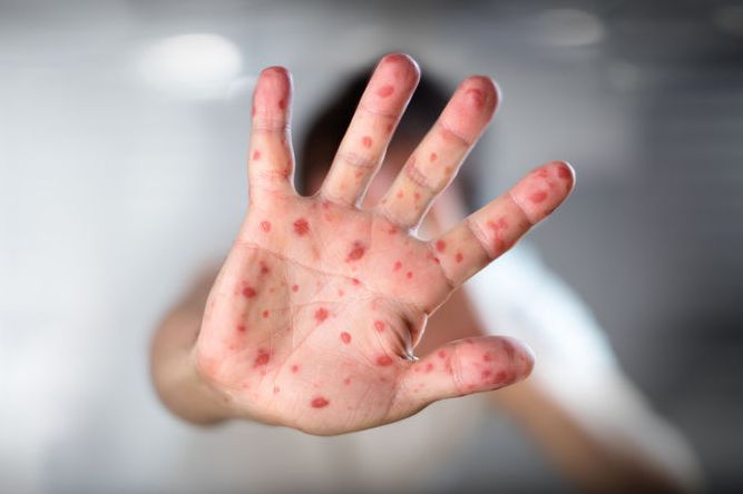 病毒性疱疹是什么病?几种方法帮助缓解症状